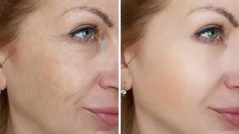 botox-vs-hyaluronic-acid-2