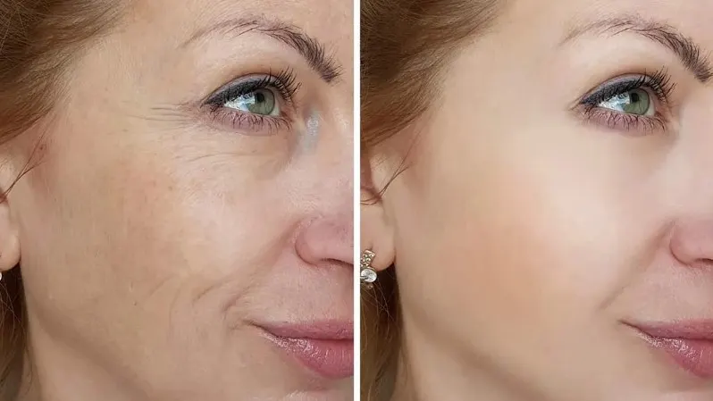 Botox vs Hyaluronic Acid Injection: Which is better? 1 botox-vs-hyaluronic-acid-2