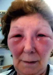 bruising-after-botox-1 bruising-after-botox-1-2
