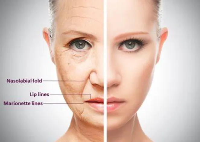 bruising-from-botox-injections-1