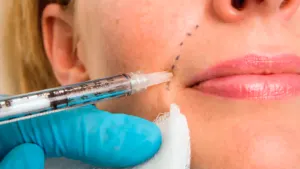 dermal fillers dermal fillers