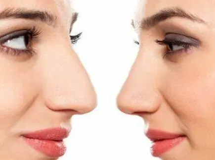 dermal-fillers-for-nose-1 dermal-fillers-for-nose-1