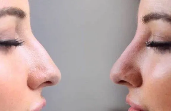 dermal-fillers-for-nose dermal-fillers-for-nose