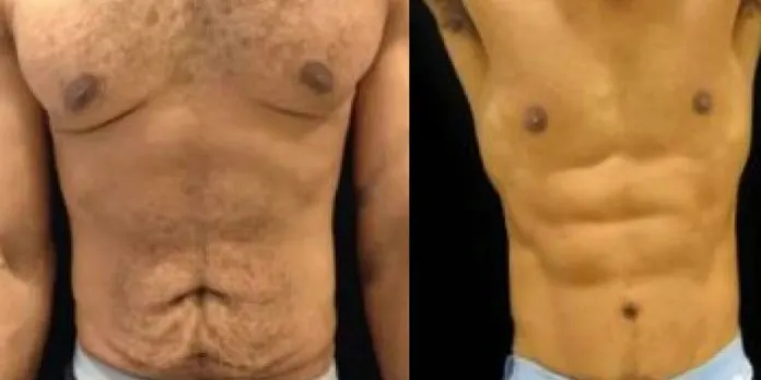 fat-transfer-for-abs-1