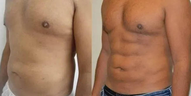fat-transfer-for-abs