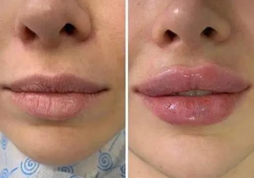hyaluronic acid vs fat transfer 1