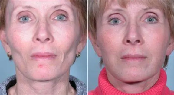 hyaluronic-acid-vs-fat-transfer-2
