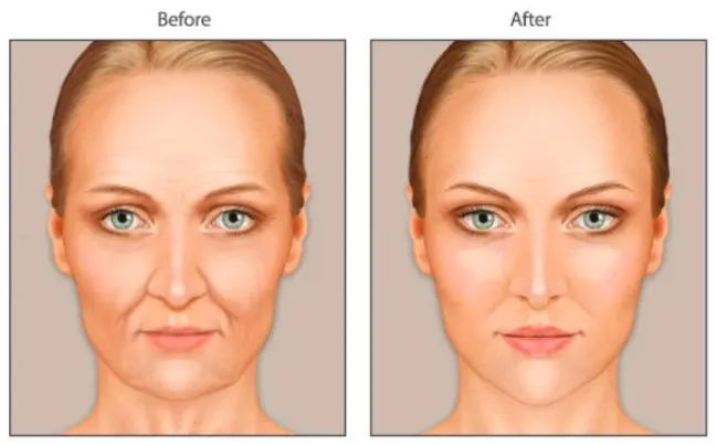 hyaluronic-acid-vs-fat-transfer