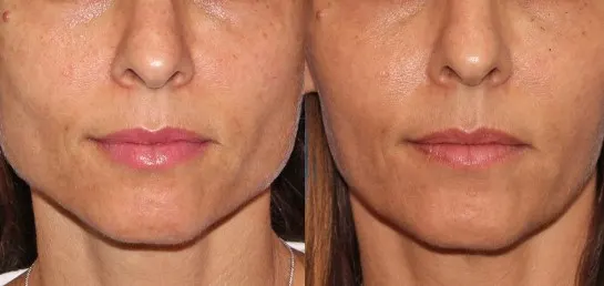 botox-for-jowls-1 botox-for-jowls-1