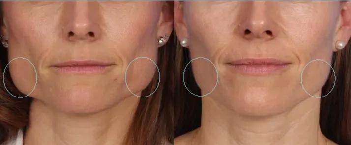 botox-for-jowls botox-for-jowls