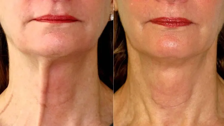 botox-for-neck-1