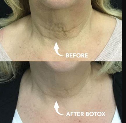 botox-for-neck-2