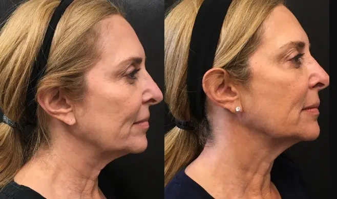 botox-for-neck