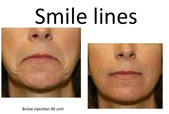 botox-for-smile-lines-1