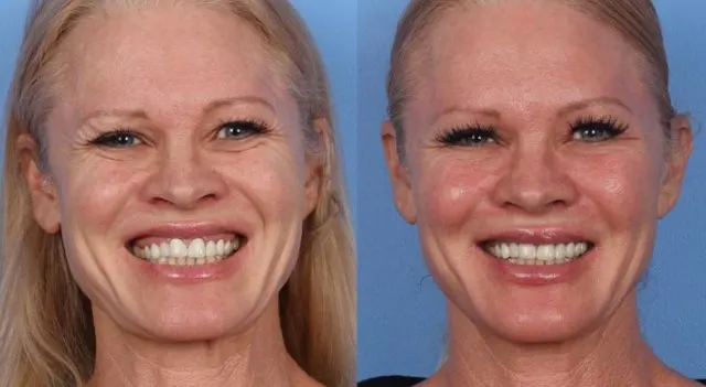 botox-for-smile-lines-2