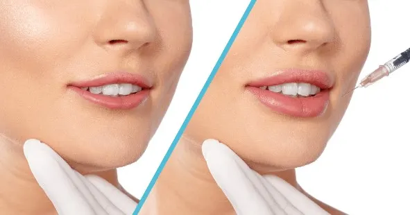 botox-for-smile-lines