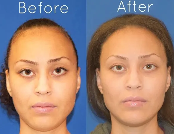 botox-masseter-before-and-after-1