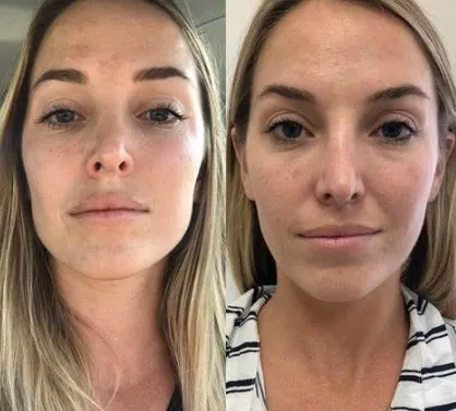 botox-masseter-before-and-after