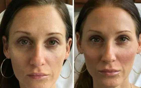 cheek-fillers-before-and-after-2