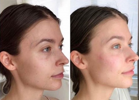 chin-filler-before-and-after-2