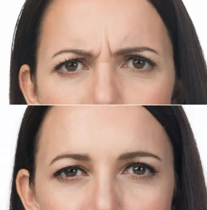 does-botox-hurt-1