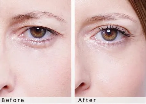 eyelid lift without surgery 2