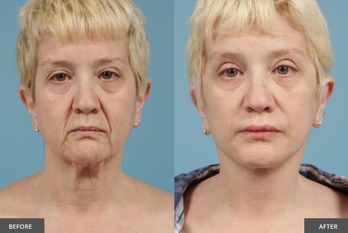 face-lift-before-and-after-1