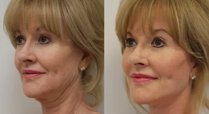 face-lift-before-and-after-2