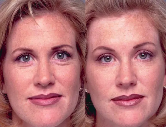 face-lift-without-surgery-1 face-lift-without-surgery-1