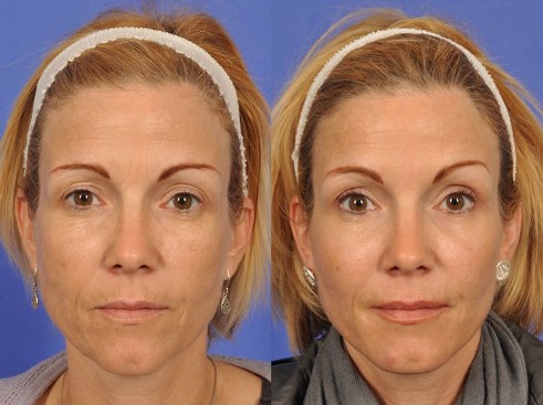 face-lift-without-surgery-2
