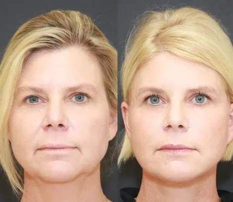 face-lift-without-surgery face-lift-without-surgery