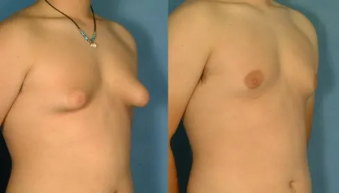 gynecomastia-treatment-without-surgery-2