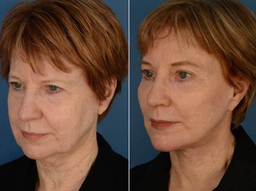 how-much-is-a-face-lift