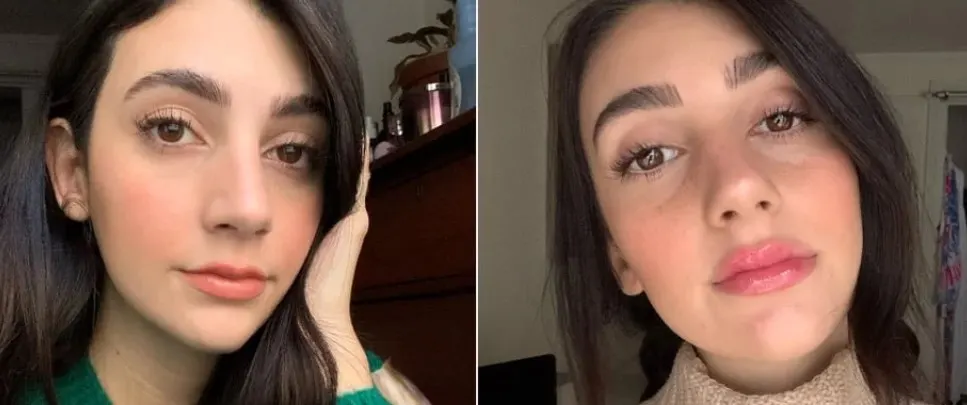 lip-filler-before-and-after-2