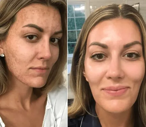 microneedling-before-and-after-2
