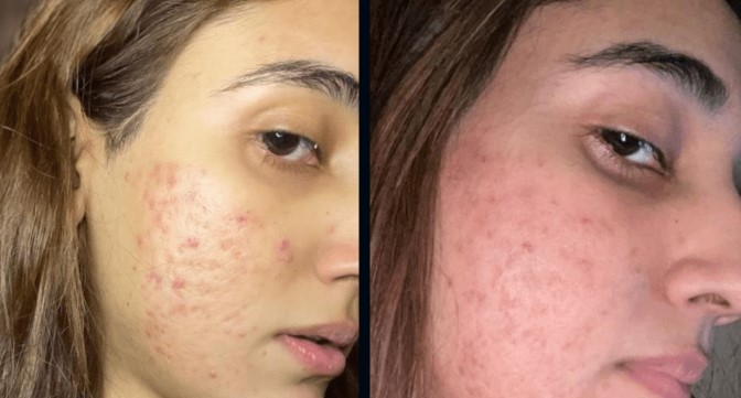 microneedling before and after 3