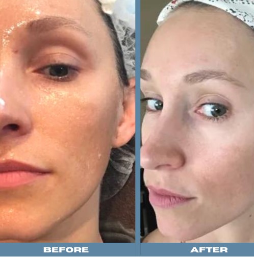 microneedling-before-and-after