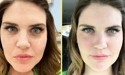 under eye filler before and after 2