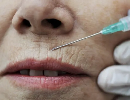 botox for smokers lines before and after
