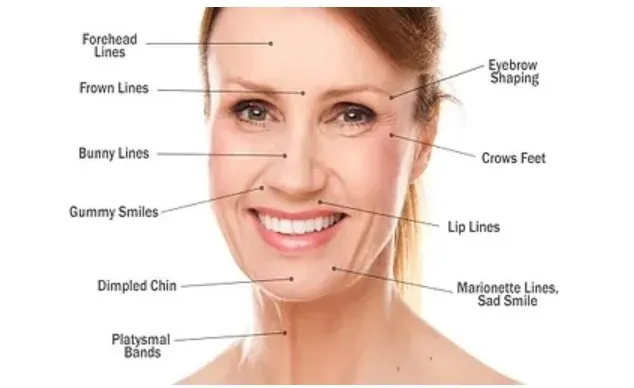 botox-smile-lift