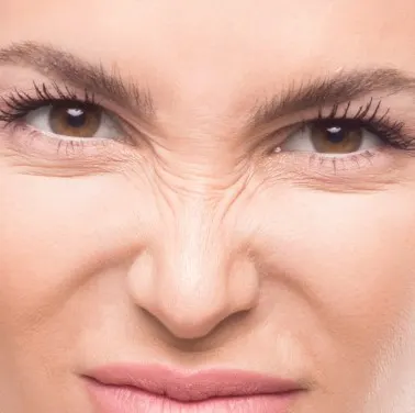 bunny-lines-botox-1-2-1