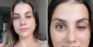 forehead-botox-gone-wrong-2
