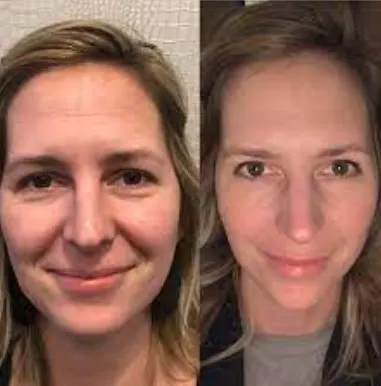 hooded-eye-botox-eyebrow-lift