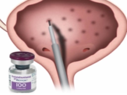 the-pros-and-cons-of-bladder-botox-1