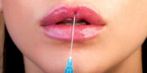 How is Lip Botox Done Your Guide to Smooth Lips